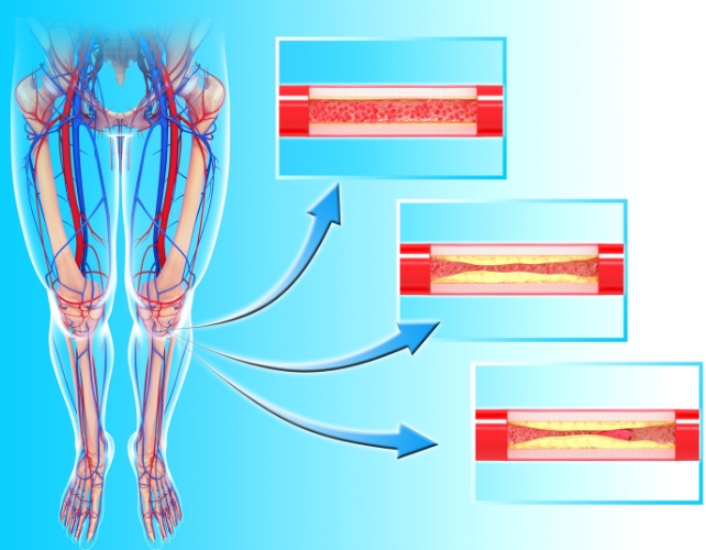 A diagram of legs and inserts showing fatty deposits blocking blood flow